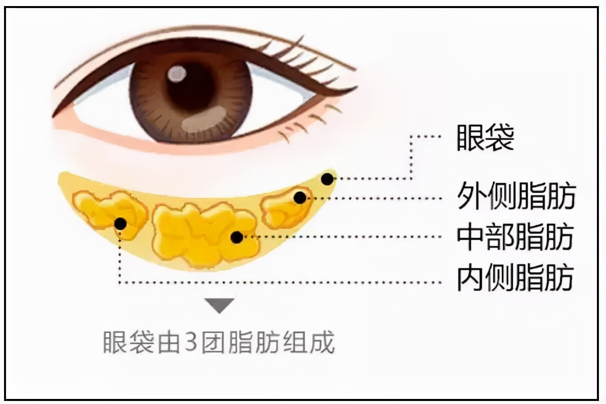 眼袋大怎么办如何解决快又好,眼袋大很显老小妙招