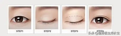 眶周治疗,眶周水肿的处理