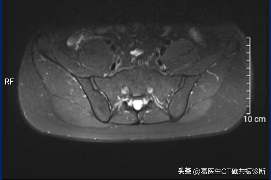 骶髂关节有必要做磁共振吗,患者担心花钱看不好病怎么回答