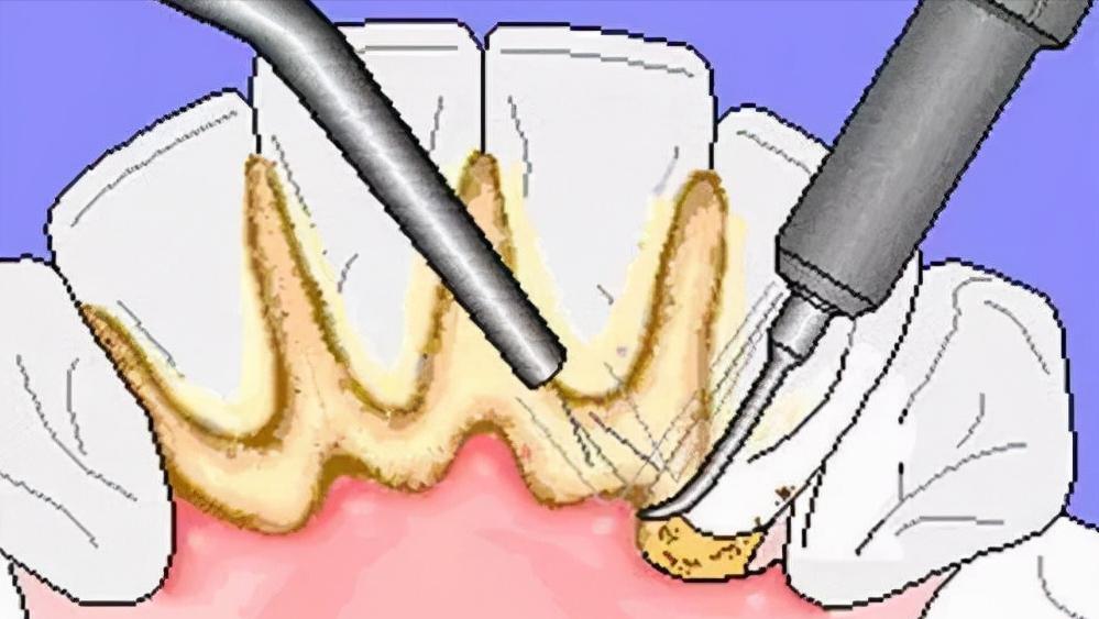 牙缝里的牙结石，如何清除干净？医生：3个办法是不少人的选择