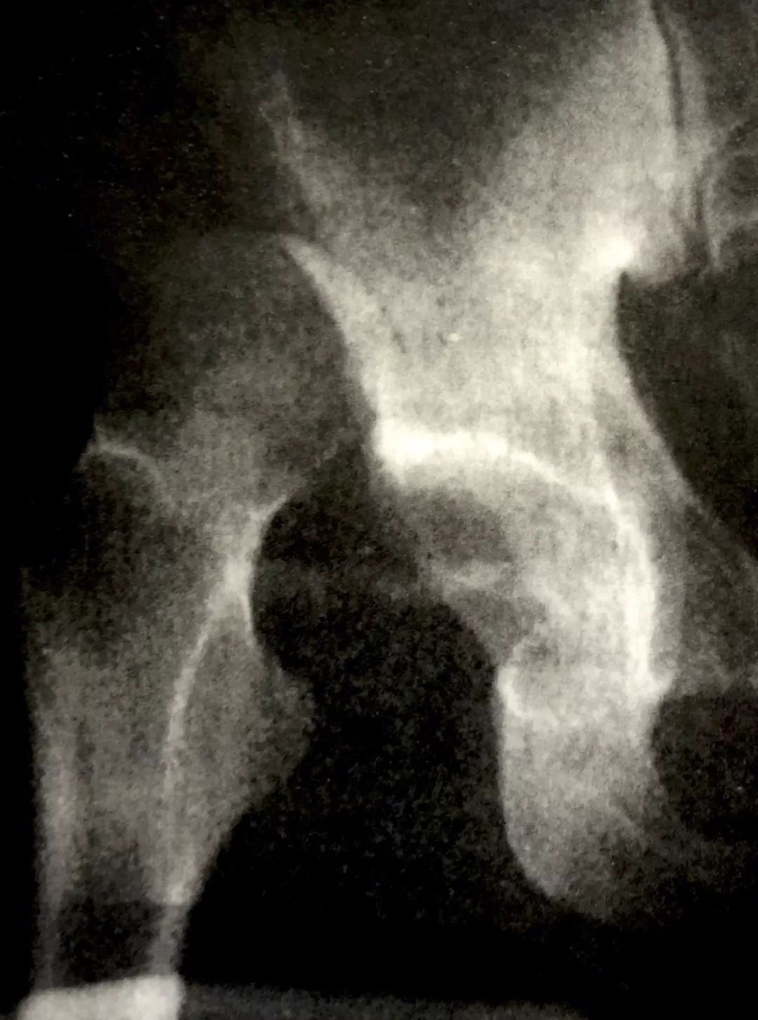 关节脱位的手法复位术操作步骤,关节脱位的手法复位