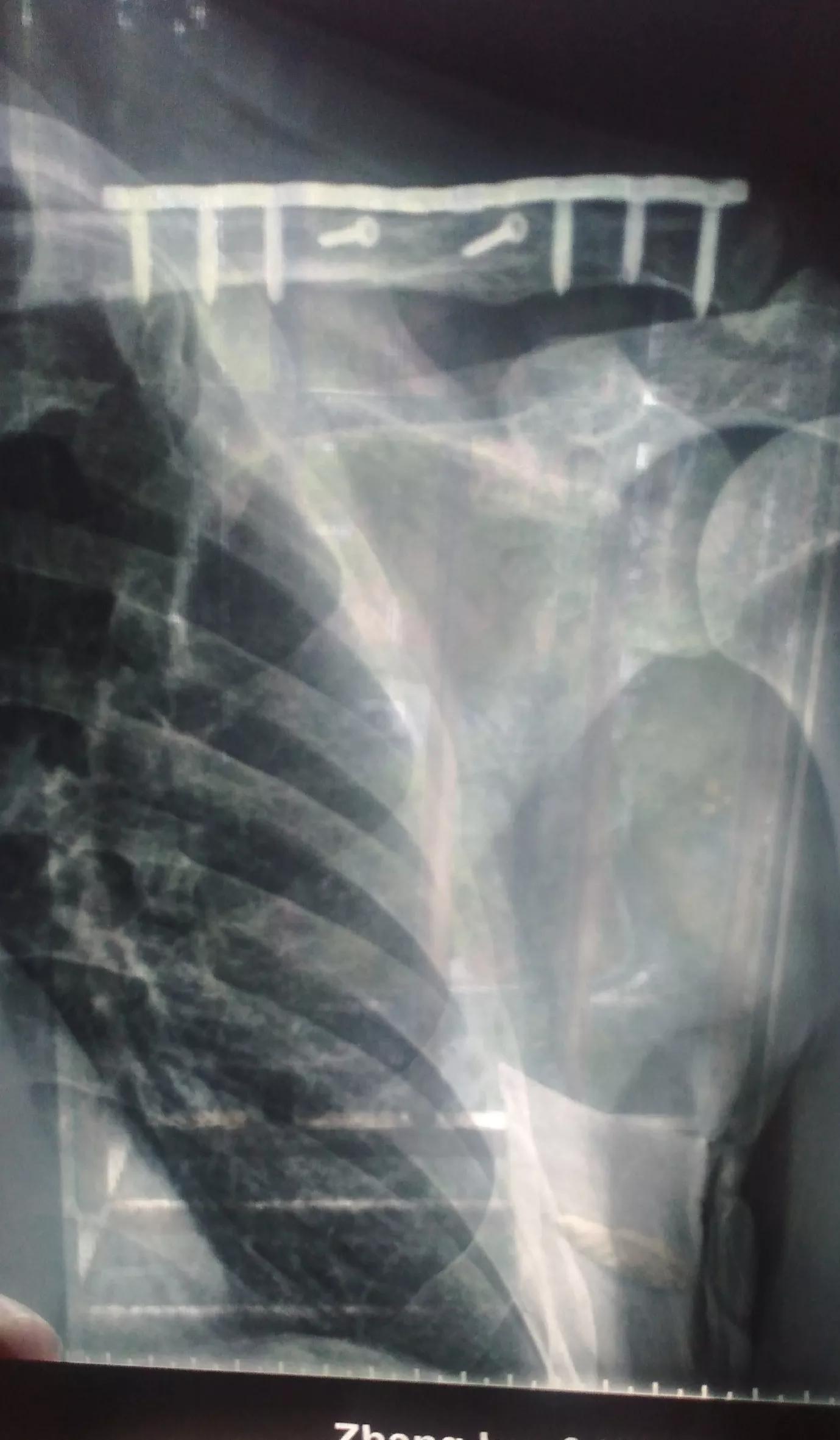 骑车摔倒肋骨骨折怎么办,骑车被摔成粉碎性骨折能痊愈吗