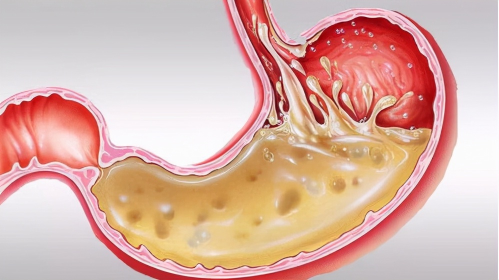 胃酸烧心怎么办快速缓解,胃酸反流引起胸闷怎么快速缓解