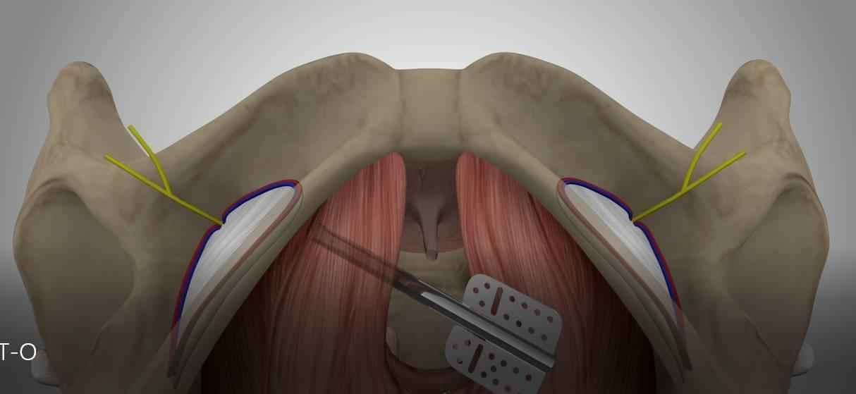 压力性尿失禁指南,压力性尿失禁治疗口诀