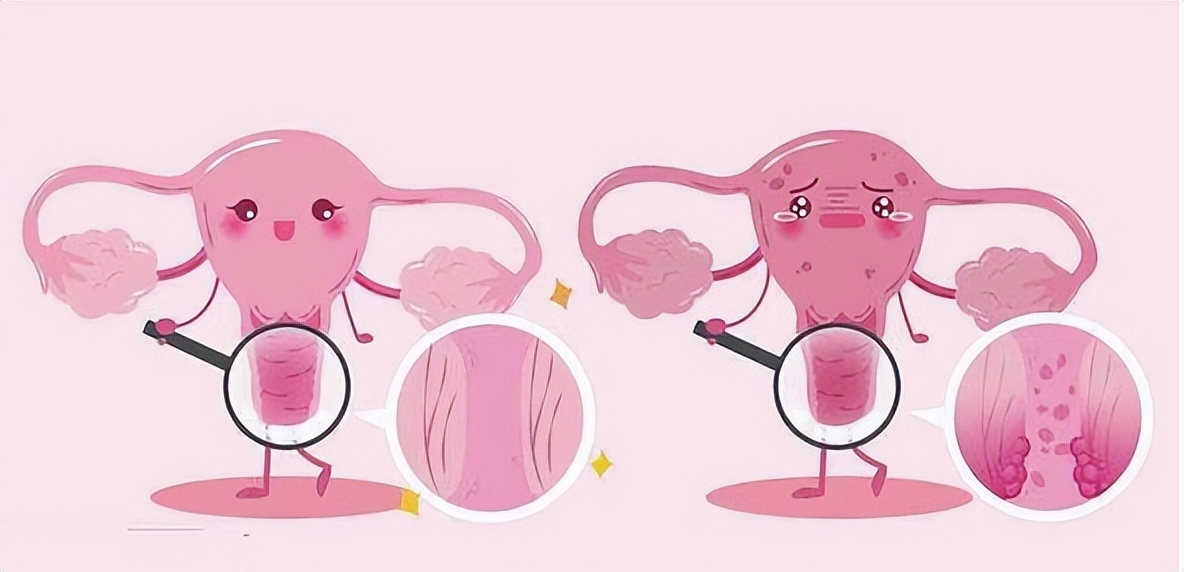 超声聚焦治疗宫颈炎出血怎么办,治疗宫颈出血微创