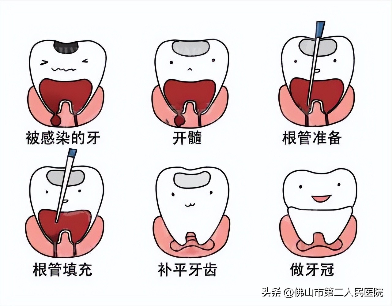 牙痛怎么快速止痛大人用花椒,生姜和花椒止牙痛