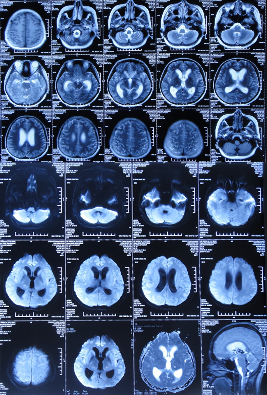结核脑炎型脑积水怎么治,结核性脑膜炎2期很严重吗