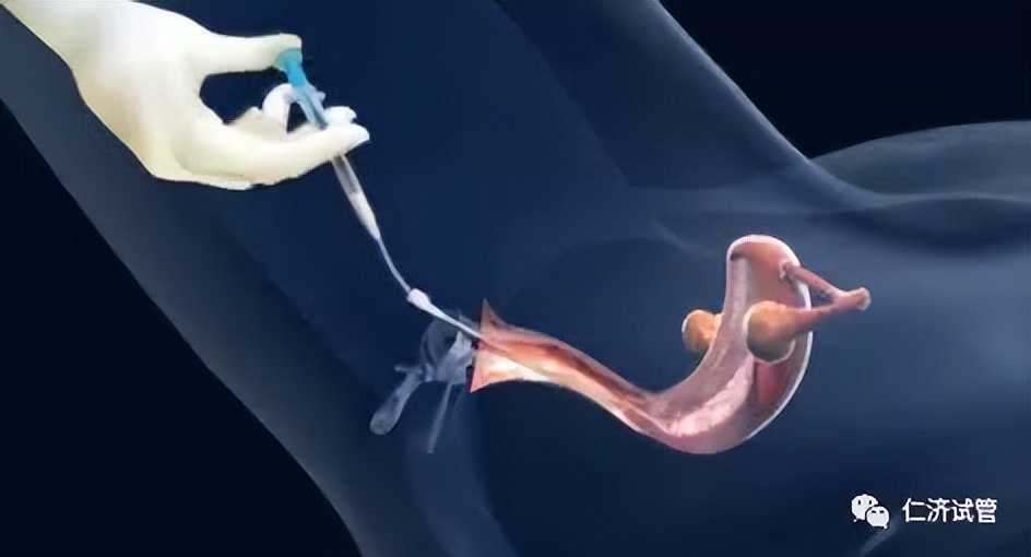 人工授精成功的症状,人工授精之前应该注意事项