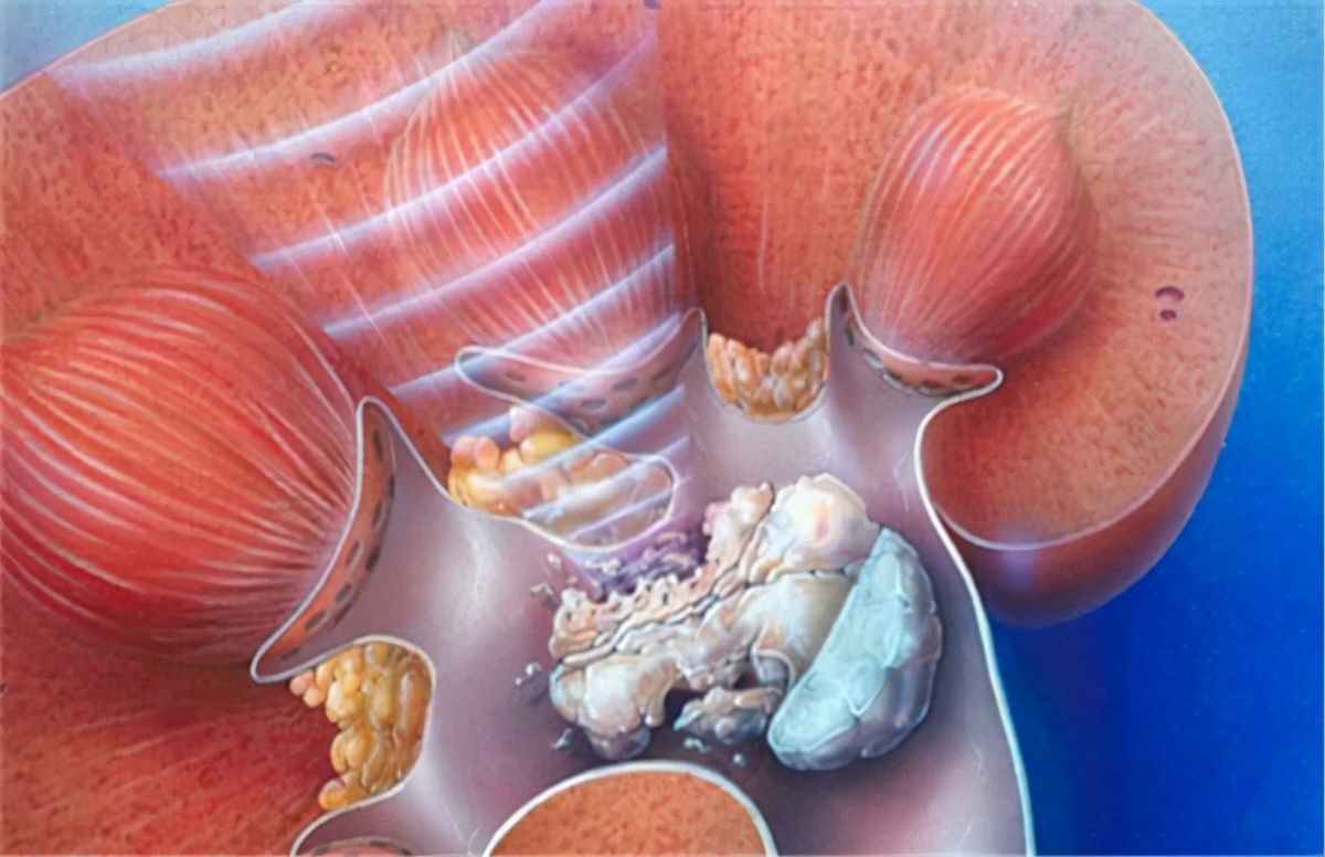 女子肾结石不痛十余年后一个肾坏死，结石如何伤肾？中医治疗方法