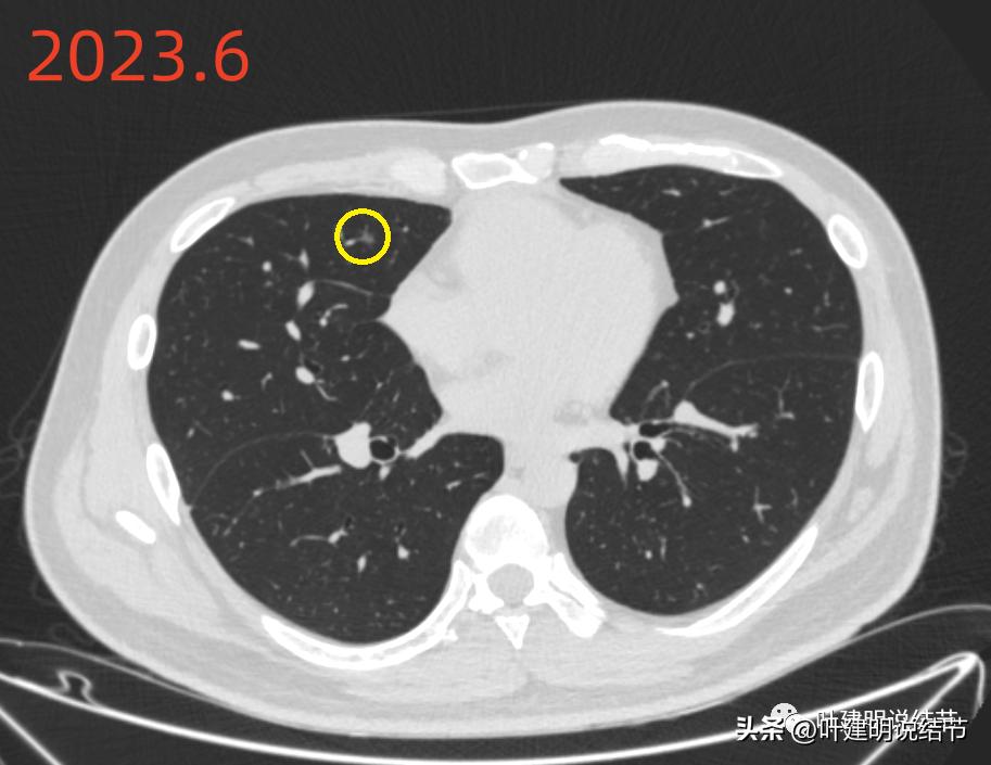 肺炎好了磨玻璃结节还存在,球形肺炎治愈后肺部留有结节