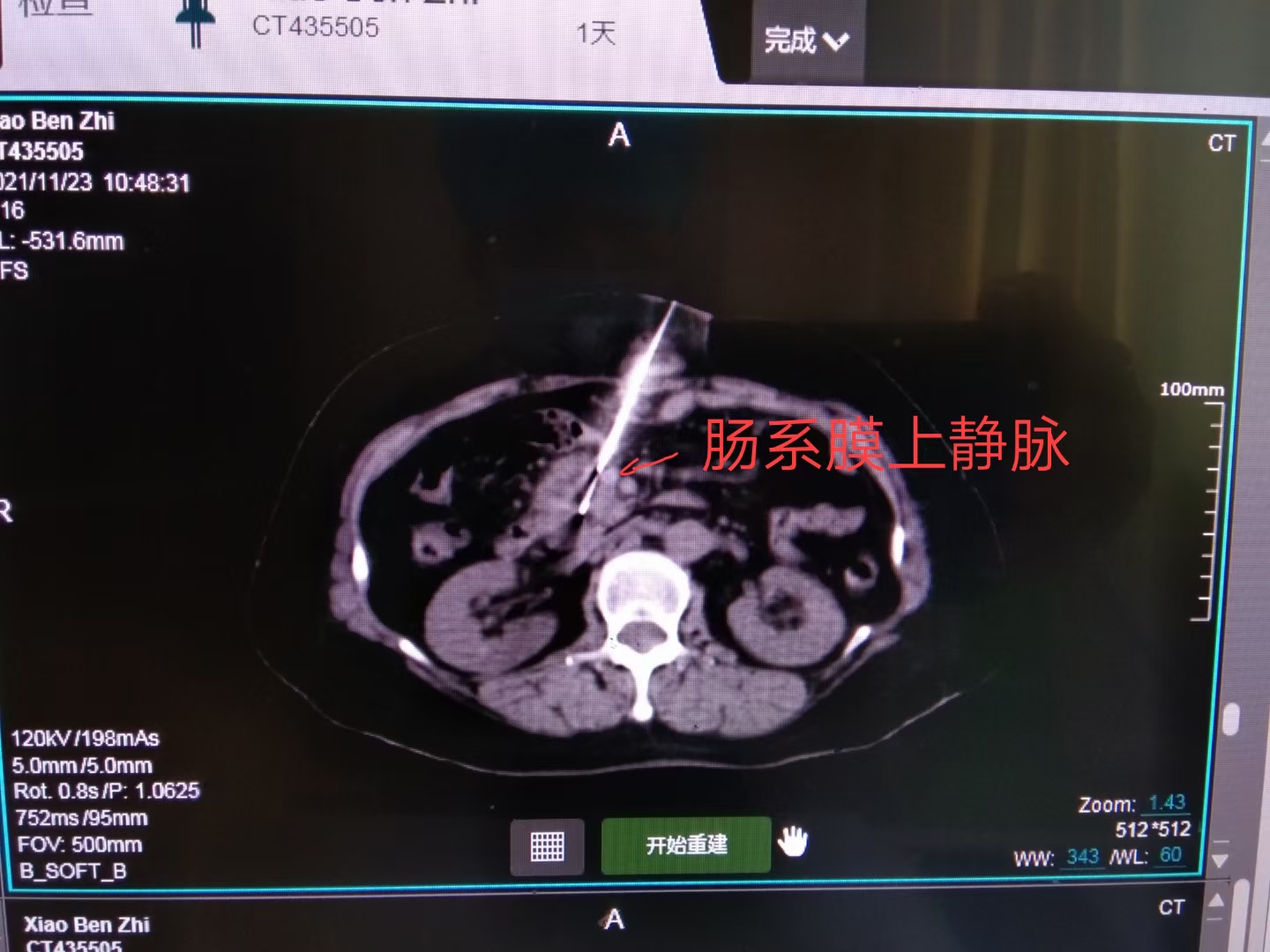 不做活检能确诊胰腺癌吗,癌中之王有多可怕