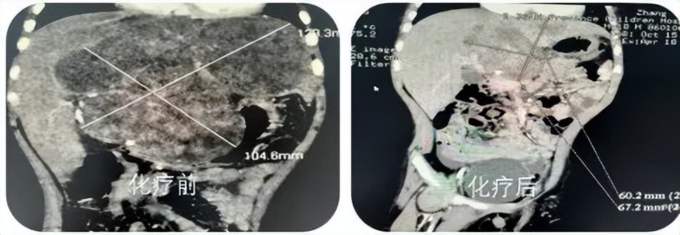 肝母细胞瘤有良恶之分吗,肝母细胞瘤罕见病