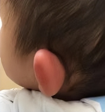 没扭伤脚肿了怎么办,宝宝脚扭伤没骨折又肿怎么办