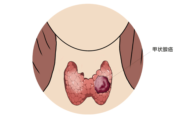 囊肿到底是什么病,囊肿属于炎症还是肿瘤