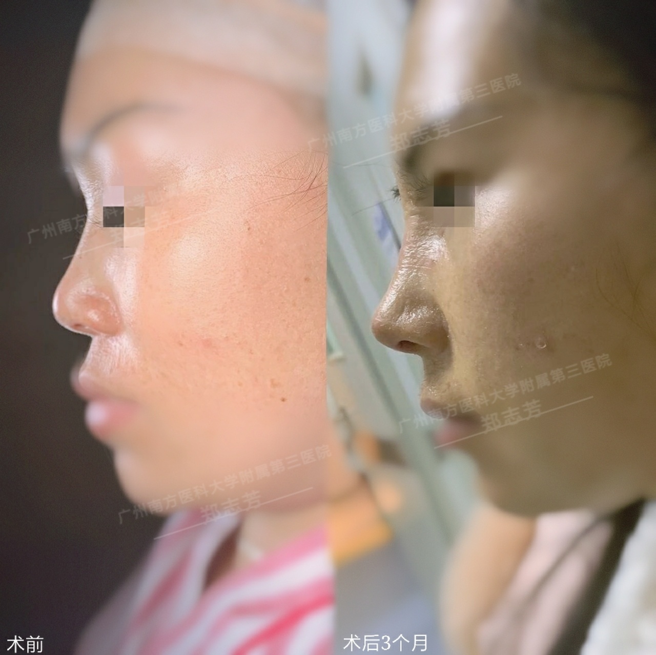 隆鼻后的注意事项和禁忌,隆鼻后需要注意的事项有哪些