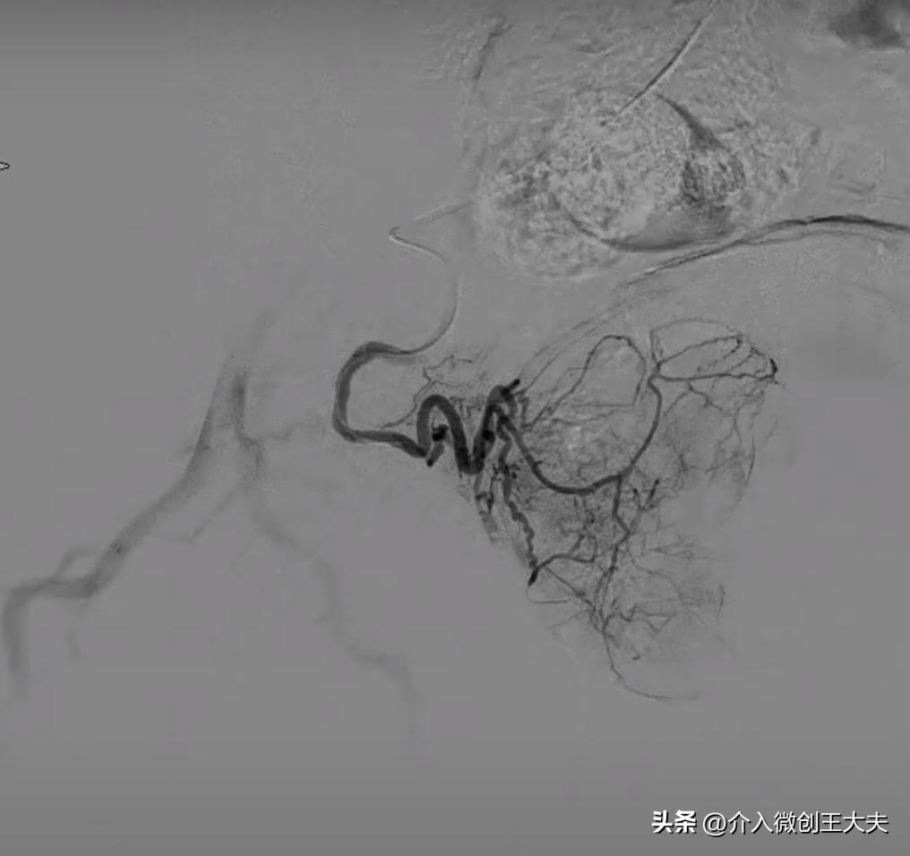 微创蒸汽消融治疗前列腺增生费用,前列腺增生微创手术前灌肠方法