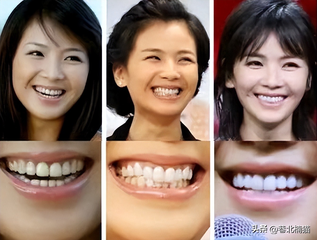 明星嘴突戴牙套前后对比,明星和假牙