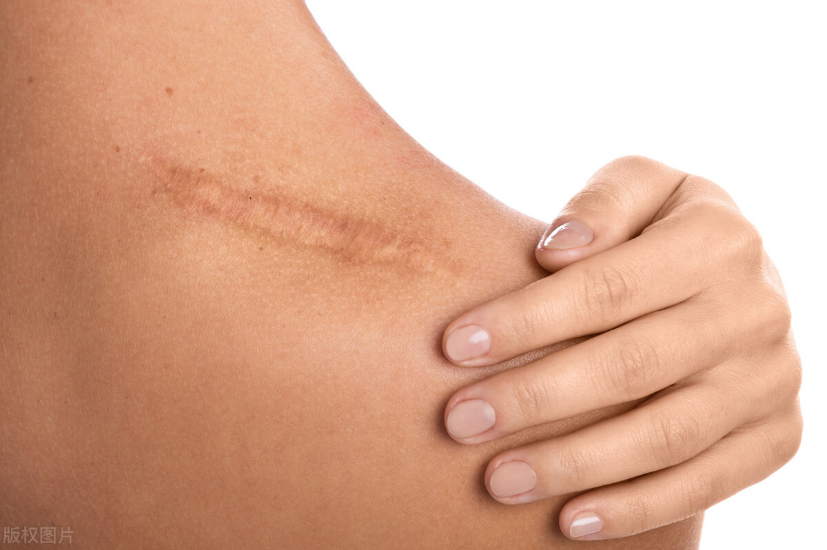 皮肤长出一个小疙瘩是什么,皮肤上长的小肉球可以自己处理吗