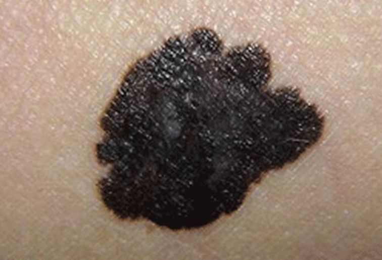 右脸上的痣要不要点掉,脸上的痣不能乱点的说法