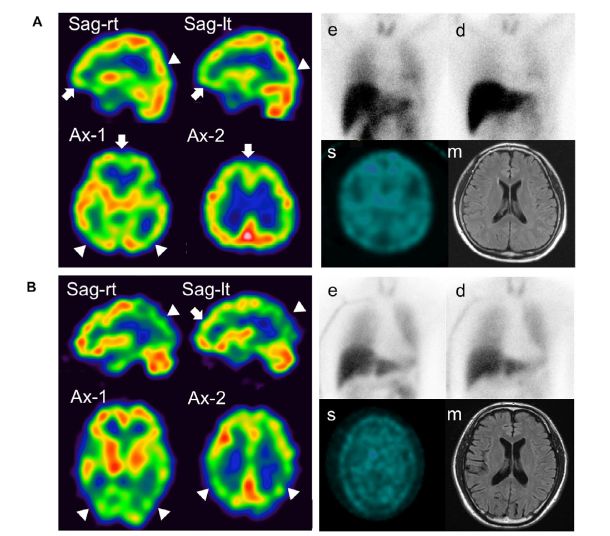 世界帕金森病日第28个主题,世界帕金森病日完整版