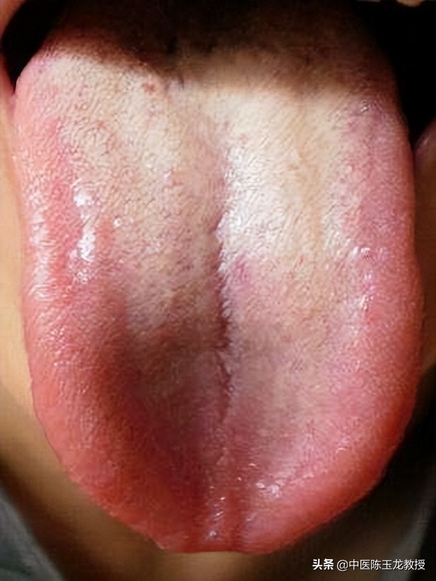 大肠湿热和膀胱湿热吃什么中成药,脾胃湿热和肝胆湿热同治的中成药