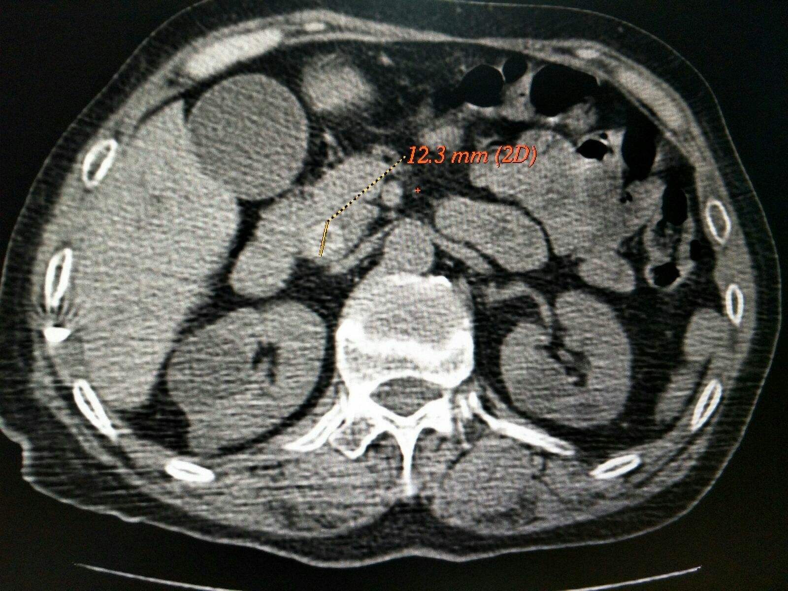 腹腔镜下胆总管切开取石治疗,充填型胆囊结石用腹腔镜怎样切除