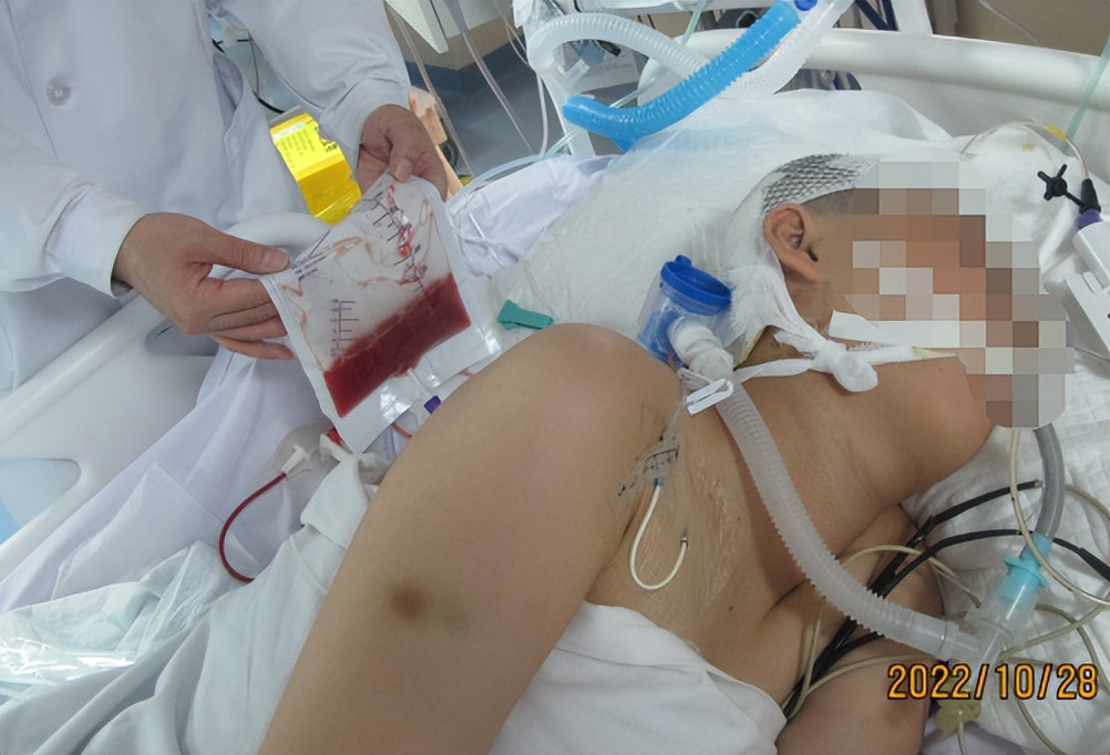 脑干出血儿童,儿童脑干胶质瘤呕吐