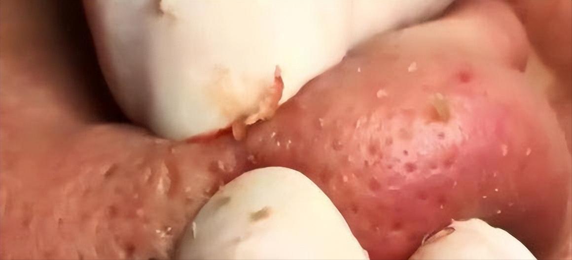 鼻子黑头感觉脏脏的,草莓黑头怎么去除最有效