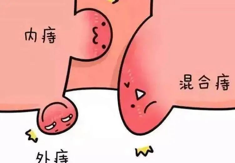 得了痔疮什么中药不能用,得了痔疮到底割还是不割
