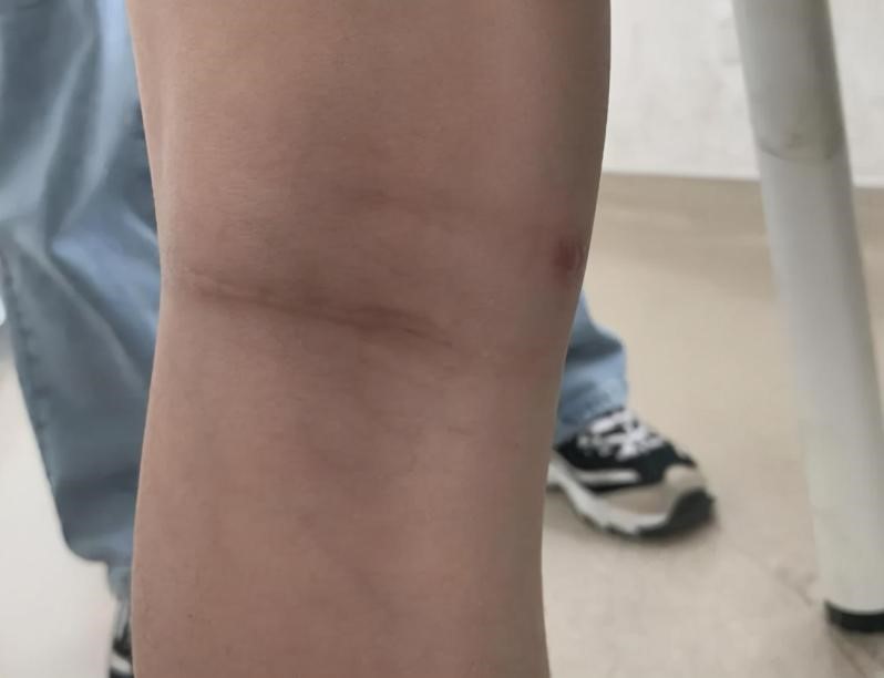 腿窝旁边起了一个鼓包是积液吗,腿左侧腘窝囊肿怎么治疗