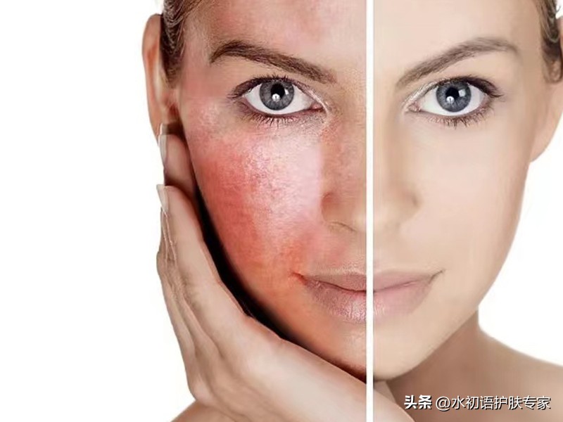 水初语祛痘技术,水初语修护敏感肌