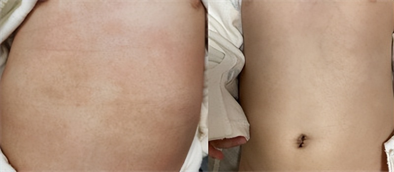 宝宝湿疹老是反反复复怎么办,宝宝湿疹反复发作该怎么办