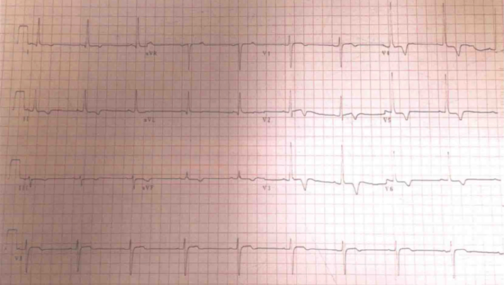 急诊PCI指南,急诊pci治疗费用