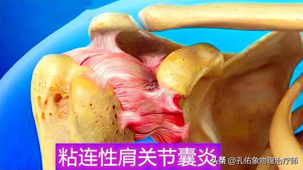 肩周炎可以自愈吗,肩周炎能不能自愈