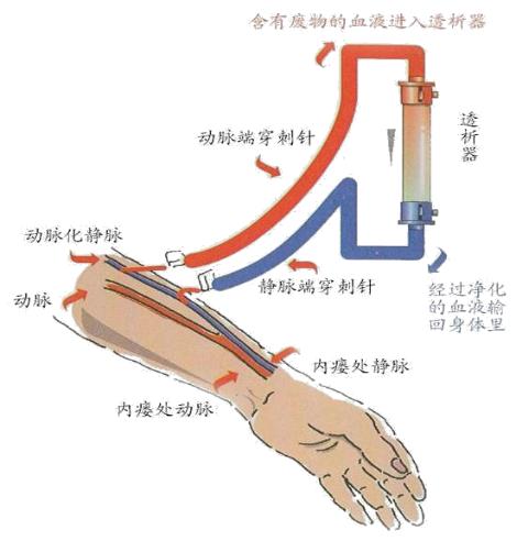 肾友注意事项有哪些,肾内动静脉瘘手术指征