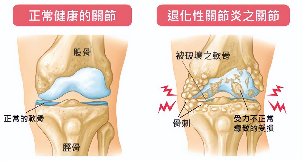 氨糖关节修复液,关节修复吃哪种氨糖