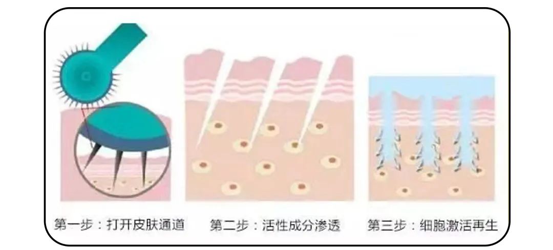 1条颈纹=显老10岁，可怕的颈纹还有救吗？