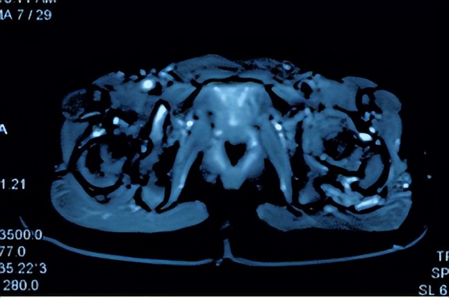 下肢肌间静脉畸形治疗案例,臀部静脉畸形怎么治疗比较好