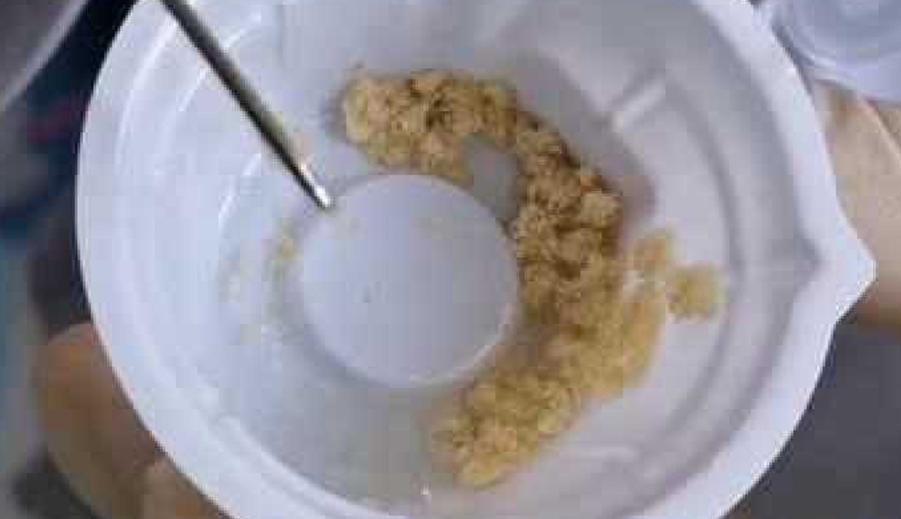 男子被烧伤医生拿来10万条虫,21岁小伙被严重烧伤