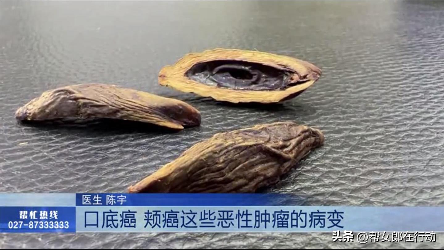 长期嚼槟榔危害有多大,珍爱生命槟榔