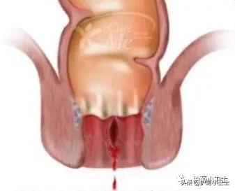 便血别担心不一定是直肠癌,便血不一定是肠癌吗
