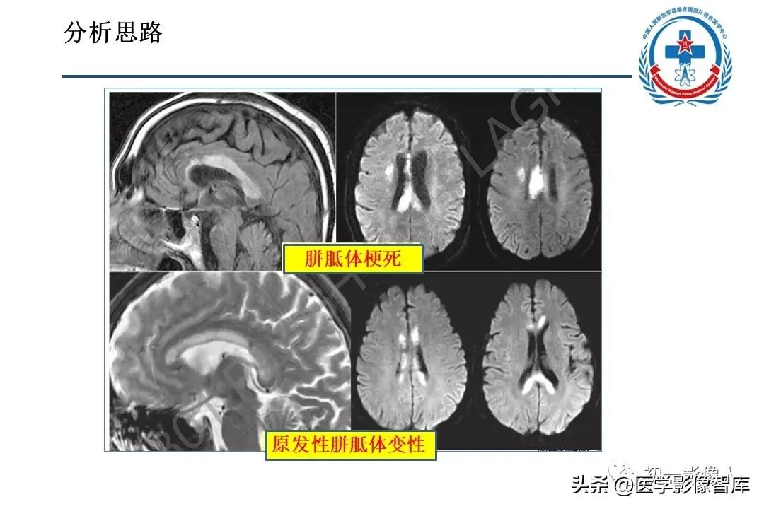 胼胝体变性治疗方法,原发性胼胝体病变治疗