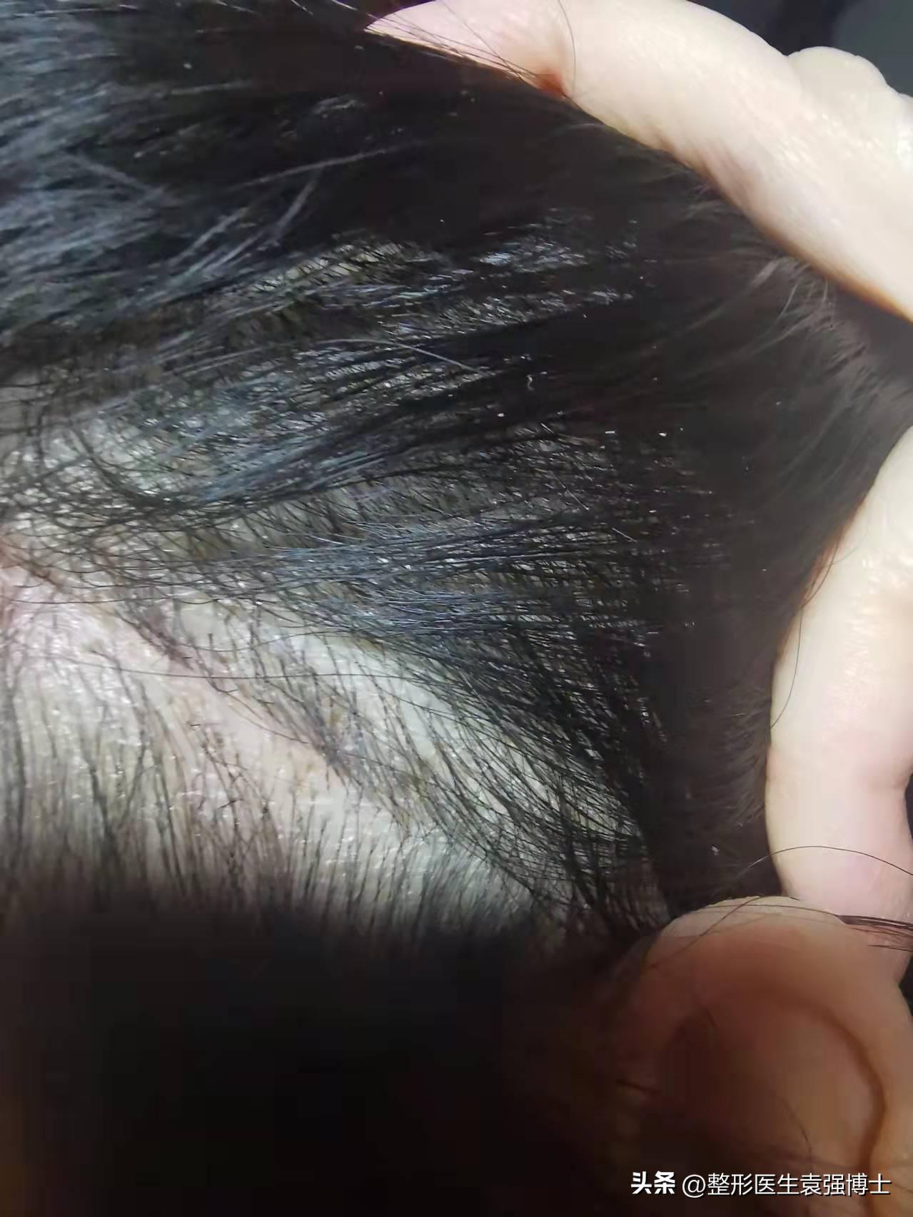 做拉皮手术前一定要明白这几点,医生不建议做拉皮手术