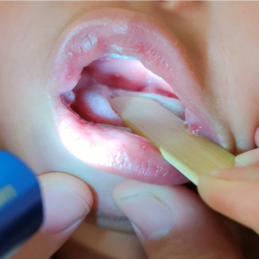 宝宝健康学堂全集,宝宝病毒感染嘴巴手脚里面长疱疹