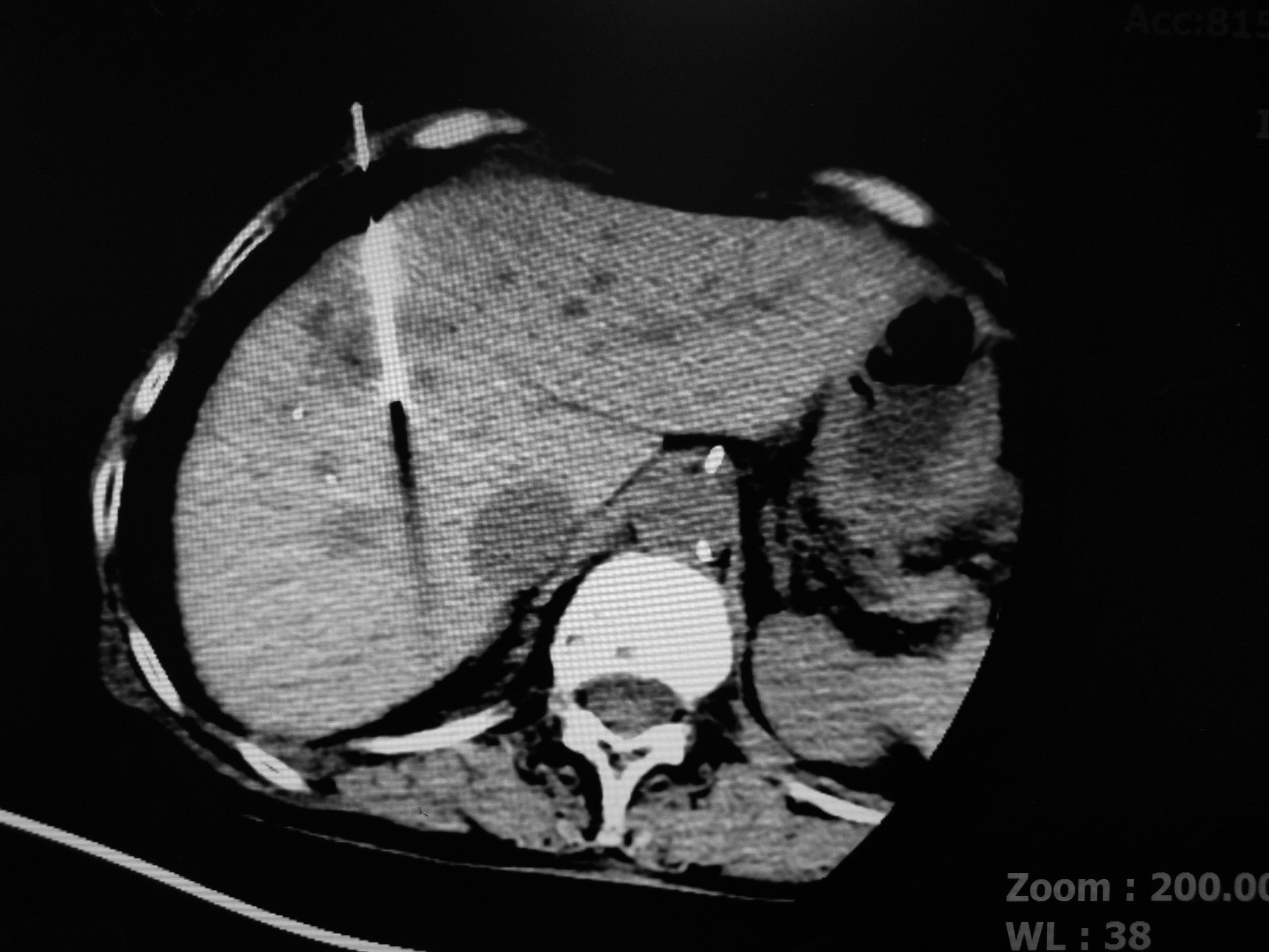 肠癌肝转移先做化疗还是介入,肠癌肝转移介入治疗哪里做得好