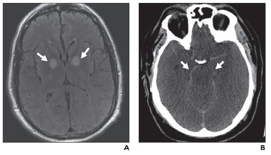 脑水肿的影像,脑水肿形成机制生理学