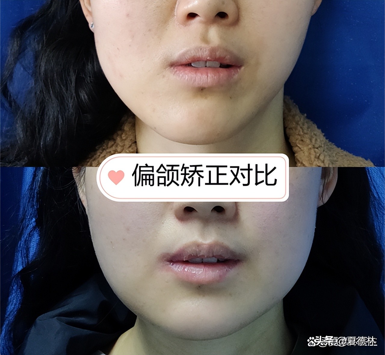 歪脸越来越严重怎么办,偏颌歪脸成人怎么改善