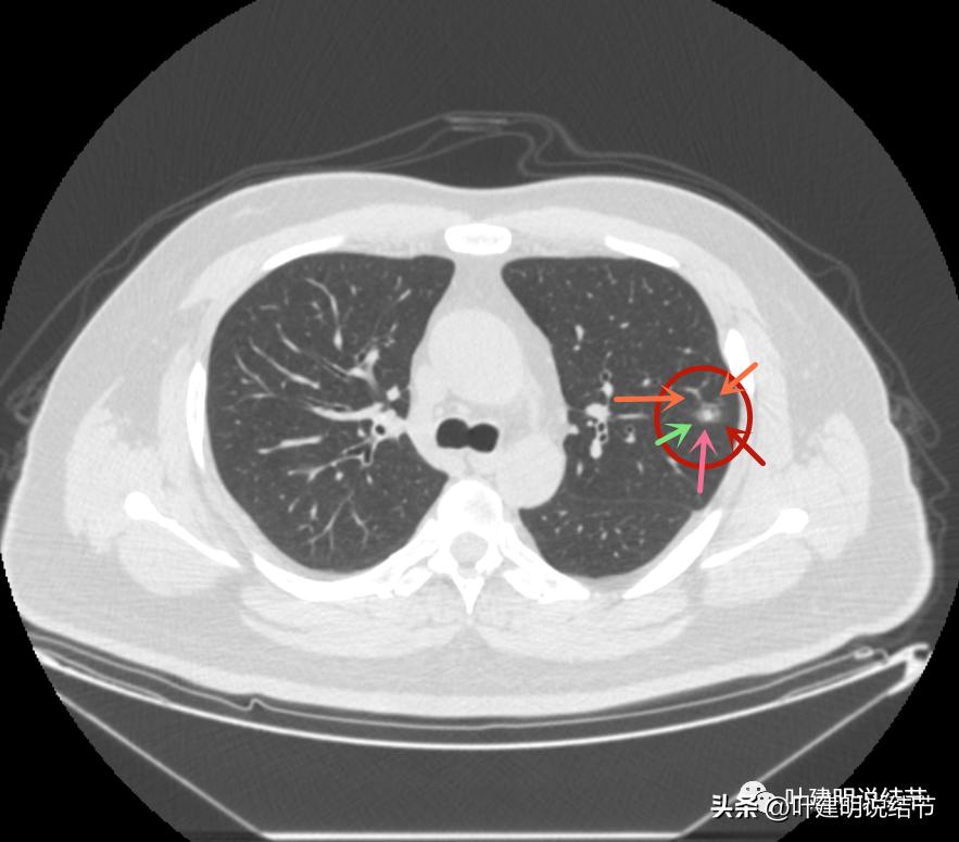如何判断肺磨玻璃结节是高危结节,肺上有混合磨玻璃结节要注意什么