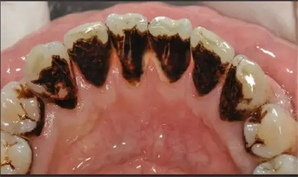 好用的国货去牙黄牙渍,去除牙渍最好的牙粉测评