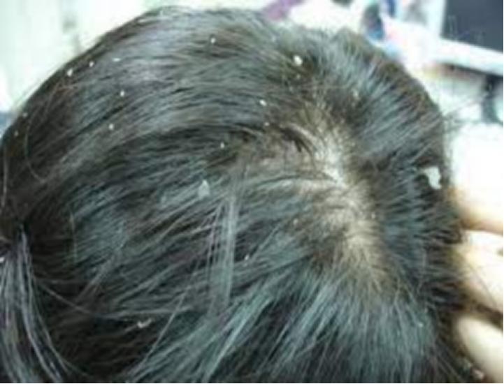 出门头皮屑多怎么去除最简单方法,头皮屑太多怎么去除最简单方法